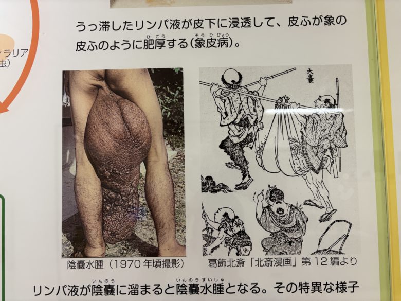 陰嚢水腫の様子