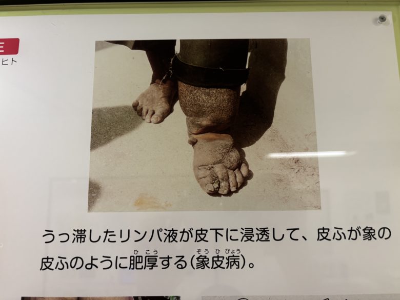 象皮病の写真